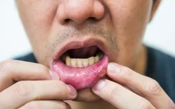 什么是口腔溃疡？反复口腔溃疡预示着哪些疾病的来临