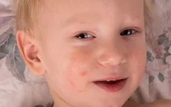 小儿荨麻疹症状是什么？小儿荨麻疹会导致窒息吗？