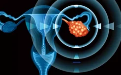 三个症状暗示宫颈癌宫颈炎与宫颈癌密切相关