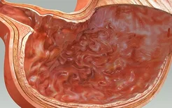 胃不舒服可能是胃癌的早期，请告诉我5个症状来判断胃癌的症状！