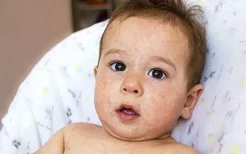 婴儿湿疹的症状,婴儿湿疹治疗方法会是什么呢