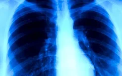 肺ct能查出肺癌吗肺部斑影是肺癌吗？